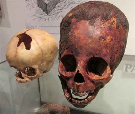 The Paracas child (right) compared with normal human child of the same age. Needless to say how very different the skull itself is!